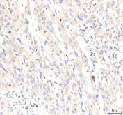 IHC staining of FFPE human urothelial carcinoma tissue with Plakophilin 2 antibody. HIER: boil tissue sections in pH8 EDTA for 20 min and allow to cool before testing.