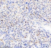 IHC staining of FFPE human liver cancer tissue with MACROH2A2 antibody. HIER: boil tissue sections in pH8 EDTA for 20 min and allow to cool before testing.