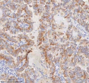 IHC staining of FFPE human thyroid papillary carcinoma tissue with MINDY4 antibody. HIER: boil tissue sections in pH8 EDTA for 20 min and allow to cool before testing.