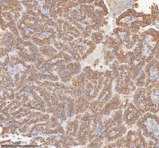 IHC staining of FFPE human thyroid papillary carcinoma tissue with MIPEP antibody. HIER: boil tissue sections in pH8 EDTA for 20 min and allow to cool before testing.