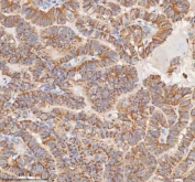 IHC staining of FFPE human thyroid papillary carcinoma tissue with MIPEP antibody. HIER: boil tissue sections in pH8 EDTA for 20 min and allow to cool before testing.