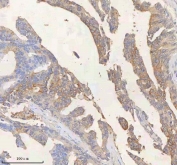 IHC staining of FFPE human rectum adenocarcinoma tissue with SCD1 antibody. HIER: boil tissue sections in pH8 EDTA for 20 min and allow to cool before testing.