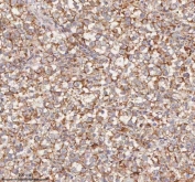 IHC staining of FFPE human testicular seminoma tissue with HDHD5 antibody. HIER: boil tissue sections in pH8 EDTA for 20 min and allow to cool before testing.