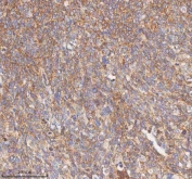 IHC staining of FFPE human cervix squamous cell carcinoma tissue with HDHD5 antibody. HIER: boil tissue sections in pH8 EDTA for 20 min and allow to cool before testing.
