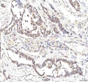 IHC staining of FFPE human pancreas ductal adenocarcinoma tissue with PHF6 antibody. HIER: boil tissue sections in pH8 EDTA for 20 min and allow to cool before testing.