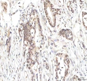IHC staining of FFPE human pancreas ductal adenocarcinoma tissue with PHF6 antibody. HIER: boil tissue sections in pH8 EDTA for 20 min and allow to cool before testing.