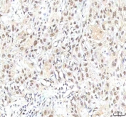 IHC staining of FFPE human urothelial carcinoma tissue with PHF6 antibody. HIER: boil tissue sections in pH8 EDTA for 20 min and allow to cool before testing.