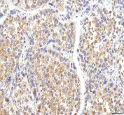 IHC staining of FFPE human liver cancer tissue with PHF6 antibody. HIER: boil tissue sections in pH8 EDTA for 20 min and allow to cool before testing.