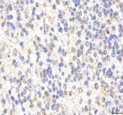 IHC staining of FFPE human glioblastoma tissue with PHF6 antibody. HIER: boil tissue sections in pH8 EDTA for 20 min and allow to cool before testing.