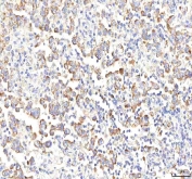 IHC staining of FFPE human testicular seminoma tissue with Phosphoglucomutase 3 antibody. HIER: boil tissue sections in pH8 EDTA for 20 min and allow to cool before testing.