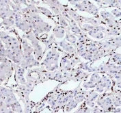 IHC staining of FFPE human liver cancer tissue with RNA-binding motif protein 3 antibody. HIER: boil tissue sections in pH8 EDTA for 20 min and allow to cool before testing.
