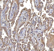 IHC staining of FFPE human lung cancer tissue with GOLGA7 antibody. HIER: boil tissue sections in pH8 EDTA for 20 min and allow to cool before testing.