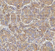 IHC staining of FFPE human liver cancer tissue with GOLGA7 antibody. HIER: boil tissue sections in pH8 EDTA for 20 min and allow to cool before testing.