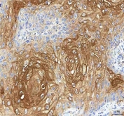 IHC staining of FFPE human skin cancer tissue with GOLGA7 antibody. HIER: boil tissue sections in pH8 EDTA for 20 min and allow to cool before testing.