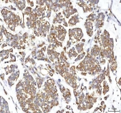 IHC staining of FFPE human breast cancer tissue with GOLGA7 antibody. HIER: boil tissue sections in pH8 EDTA for 20 min and allow to cool before testing.