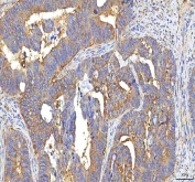 IHC staining of FFPE human rectum adenocarcinoma tissue with GOLGA7 antibody. HIER: boil tissue sections in pH8 EDTA for 20 min and allow to cool before testing.