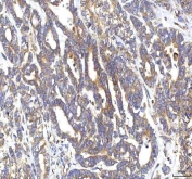 IHC staining of FFPE human ovarian cancer tissue with GOLGA7 antibody. HIER: boil tissue sections in pH8 EDTA for 20 min and allow to cool before testing.