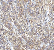 IHC staining of FFPE human urothelial carcinoma tissue with GOLGA7 antibody. HIER: boil tissue sections in pH8 EDTA for 20 min and allow to cool before testing.
