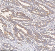 IHC staining of FFPE human colon adenocarcinoma tissue with HER4 antibody. HIER: boil tissue sections in pH8 EDTA for 20 min and allow to cool before testing.