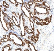 IHC staining of FFPE human thyroid papillary carcinoma tissue with PKDCC antibody. HIER: boil tissue sections in pH8 EDTA for 20 min and allow to cool before testing.