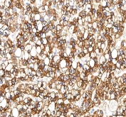 IHC staining of FFPE human liver cancer tissue with PKDCC antibody. HIER: boil tissue sections in pH8 EDTA for 20 min and allow to cool before testing.