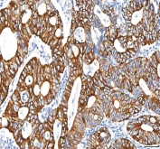 IHC staining of FFPE human colon adenocarcinoma tissue with PKDCC antibody. HIER: boil tissue sections in pH8 EDTA for 20 min and allow to cool before testing.