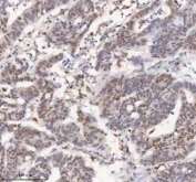 IHC staining of FFPE human colon adenocarcinoma tissue with MACROH2A1 antibody. HIER: boil tissue sections in pH8 EDTA for 20 min and allow to cool before testing.