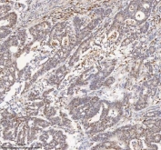 IHC staining of FFPE human colon adenocarcinoma tissue with MACROH2A1 antibody. HIER: boil tissue sections in pH8 EDTA for 20 min and allow to cool before testing.