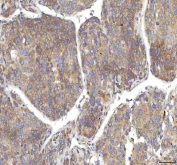 IHC staining of FFPE human liver cancer tissue with Oncomodulin 1 antibody. HIER: boil tissue sections in pH8 EDTA for 20 min and allow to cool before testing.