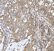 IHC staining of FFPE human lung cancer tissue with Oncomodulin 1 antibody. HIER: boil tissue sections in pH8 EDTA for 20 min and allow to cool before testing.