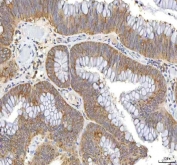 IHC staining of FFPE human colon adenocarcinoma tissue with Oncomodulin 1 antibody. HIER: boil tissue sections in pH8 EDTA for 20 min and allow to cool before testing.