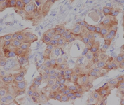 Phospho-mTOR Antibody Breast Cancer IHC. Immunohistochemistry analysis of FFPE human breast carcinoma tissue stained with phospho-mTOR antibody detecting mTOR phosphorylated at Ser2448, clone IFF-13. Tumor epithelial cells show cytoplasmic HRP-DAB brown staining with moderate intensity, consistent with activation of mTOR signaling and protein synthesis pathways within malignant cell populations. Surrounding stromal cells display lower staining, while nuclei are counterstained blue. HIER: boil tissue sections in pH8 EDTA for 20 min and allow to cool before testing.
