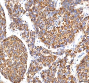 IHC staining of FFPE human liver cancer tissue with HSDL2 antibody. HIER: boil tissue sections in pH8 EDTA for 20 min and allow to cool before testing.