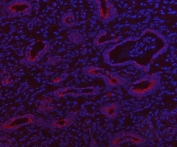 Immunofluorescent staining of FFPE human intestinal cancer tissue with HSDL2 antibody (red) and DAPI nuclear stain (blue). HIER: steam section in pH8 EDTA buffer for 20 min.