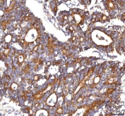 IHC staining of FFPE human colon adenocarcinoma tissue with HSDL2 antibody. HIER: boil tissue sections in pH8 EDTA for 20 min and allow to cool before testing.