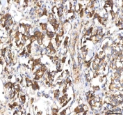 IHC staining of FFPE human lung cancer tissue with HSDL2 antibody. HIER: boil tissue sections in pH8 EDTA for 20 min and allow to cool before testing.
