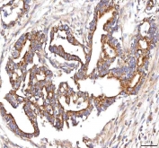 IHC staining of FFPE human pancreas ductal adenocarcinoma tissue with HSDL2 antibody. HIER: boil tissue sections in pH8 EDTA for 20 min and allow to cool before testing.