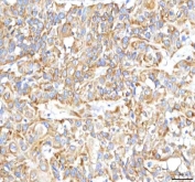 IHC staining of FFPE human urothelial carcinoma tissue with HSDL2 antibody. HIER: boil tissue sections in pH8 EDTA for 20 min and allow to cool before testing.
