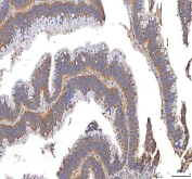 IHC staining of FFPE human colon carcinoma tissue with XDH antibody. HIER: boil tissue sections in pH8 EDTA for 20 min and allow to cool before testing.