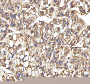 IHC staining of FFPE human liver cancer tissue with XDH antibody. HIER: boil tissue sections in pH8 EDTA for 20 min and allow to cool before testing.