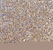 IHC staining of FFPE human diffuse large B cell lymphoma tissue with PFKP antibody. HIER: boil tissue sections in pH8 EDTA for 20 min and allow to cool before testing.
