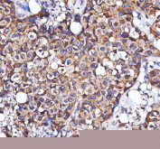 IHC staining of FFPE human breast cancer tissue with MLKL antibody. HIER: boil tissue sections in pH8 EDTA for 20 min and allow to cool before testing.