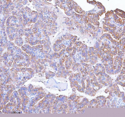 IHC staining of FFPE human thyroid papillary carcinoma tissue with MLKL antibody. HIER: boil tissue sections in pH8 EDTA for 20 min and allow to cool before testing.