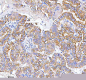 IHC staining of FFPE human thyroid papillary carcinoma tissue with MLKL antibody. HIER: boil tissue sections in pH8 EDTA for 20 min and allow to cool before testing.