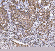 IHC staining of FFPE human breast cancer tissue with MLKL antibody. HIER: boil tissue sections in pH8 EDTA for 20 min and allow to cool before testing.