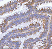 IHC staining of FFPE human colon adenocarcinoma tissue with MLKL antibody. HIER: boil tissue sections in pH8 EDTA for 20 min and allow to cool before testing.