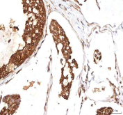 IHC staining of FFPE human breast cancer tissue with INTU antibody. HIER: boil tissue sections in pH8 EDTA for 20 min and allow to cool before testing.