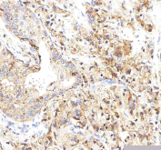 IHC staining of FFPE human prostate cancer tissue with INTU antibody. HIER: boil tissue sections in pH8 EDTA for 20 min and allow to cool before testing.