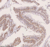 IHC staining of FFPE human human colon adenocarcinoma tissue with IRS4 antibody. HIER: boil tissue sections in pH8 EDTA for 20 min and allow to cool before testing.