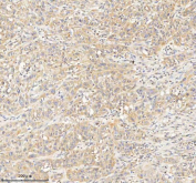 IHC staining of FFPE human pancreas ductal adenocarcinoma tissue with HDHD2 antibody. HIER: boil tissue sections in pH8 EDTA for 20 min and allow to cool before testing.